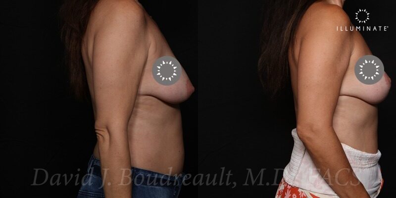 Mastopexy Before & After Image