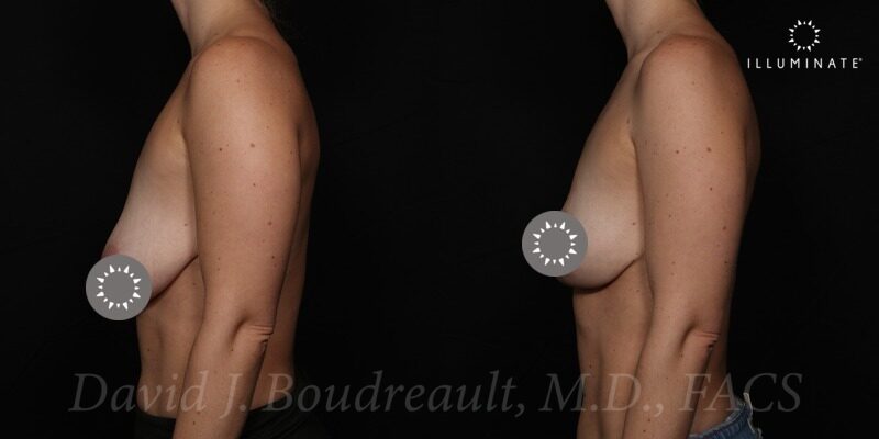 Mastopexy Before & After Image