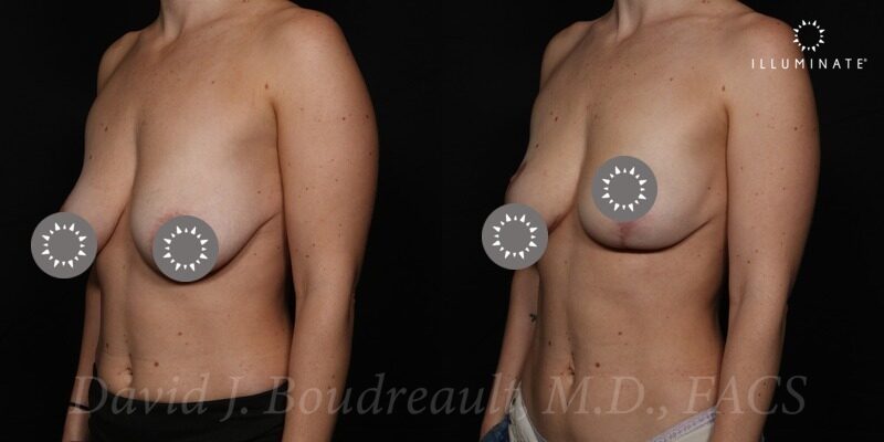 Mastopexy Before & After Image