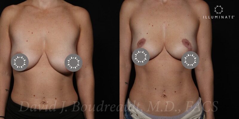 Mastopexy Before & After Image