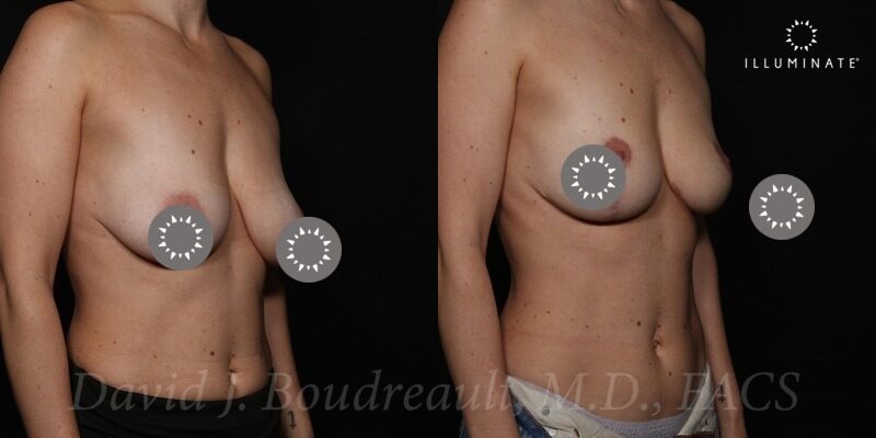 Mastopexy Before & After Image