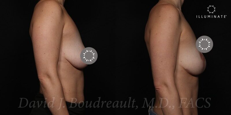 Mastopexy Before & After Image