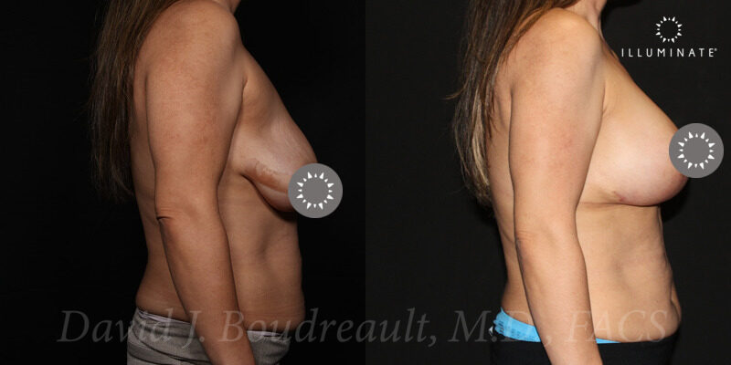 Mastopexy Before & After Image