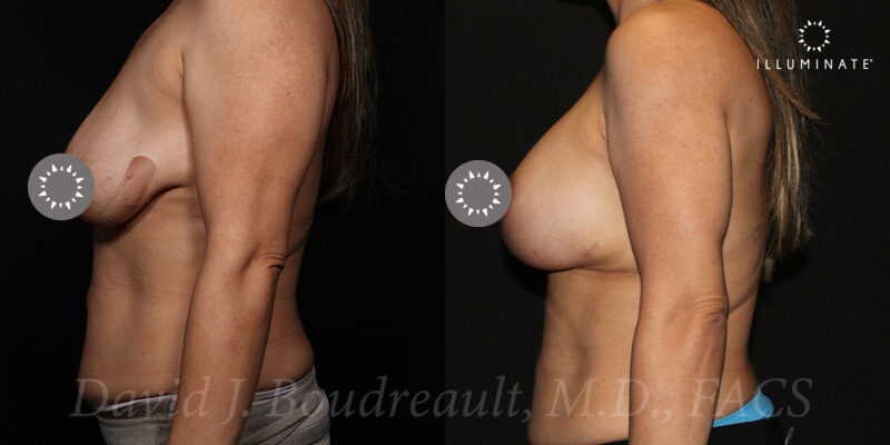 Mastopexy Before & After Image
