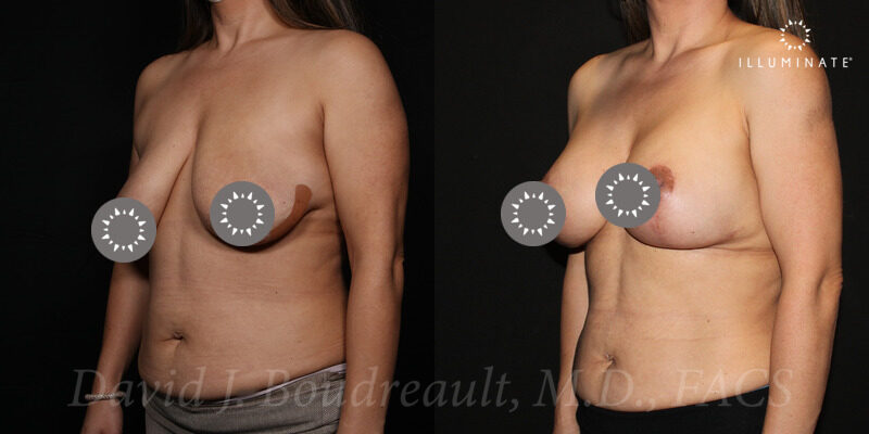 Mastopexy Before & After Image