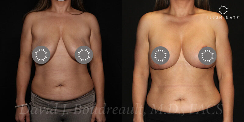 Mastopexy Before & After Image