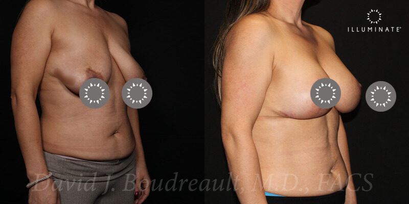 Mastopexy Before & After Image