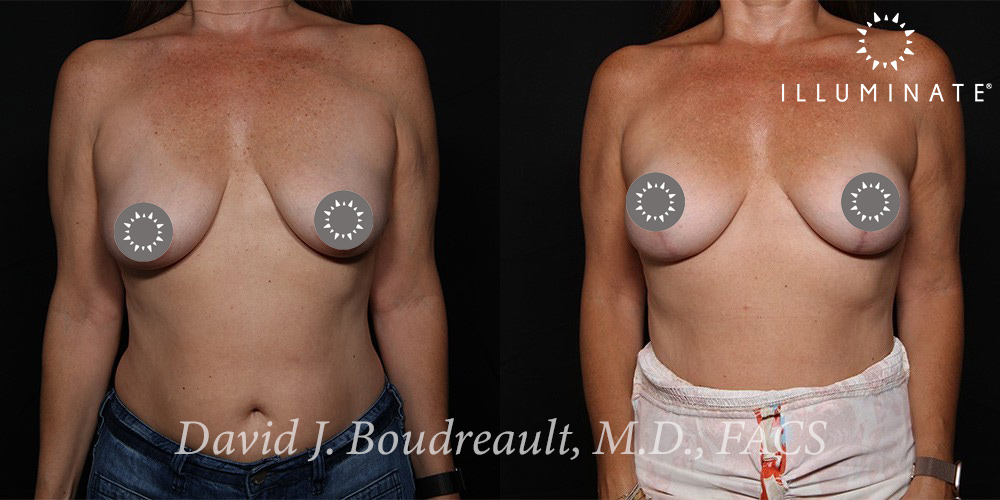 Mastopexy Before & After Image