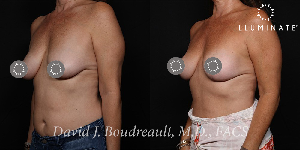 Mastopexy Before & After Image