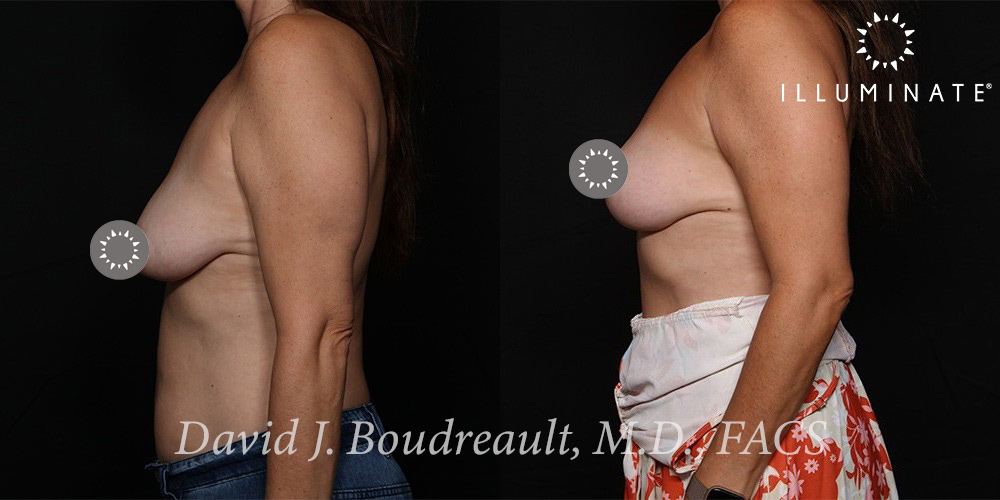 Mastopexy Before & After Image