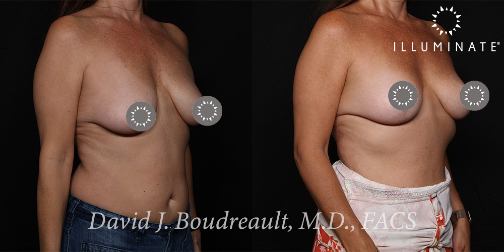 Mastopexy Before & After Image