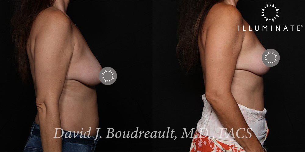 Mastopexy Before & After Image