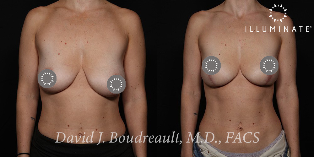 Mastopexy Before & After Image