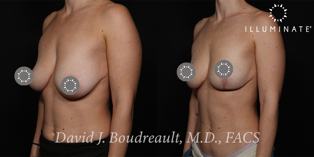 Mastopexy Before & After Image