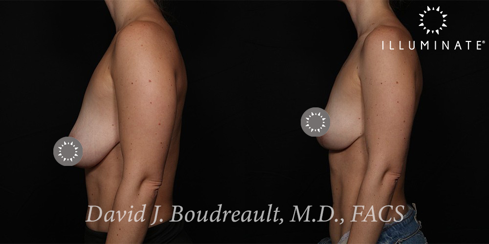 Mastopexy Before & After Image