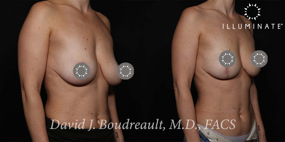 Mastopexy Before & After Image