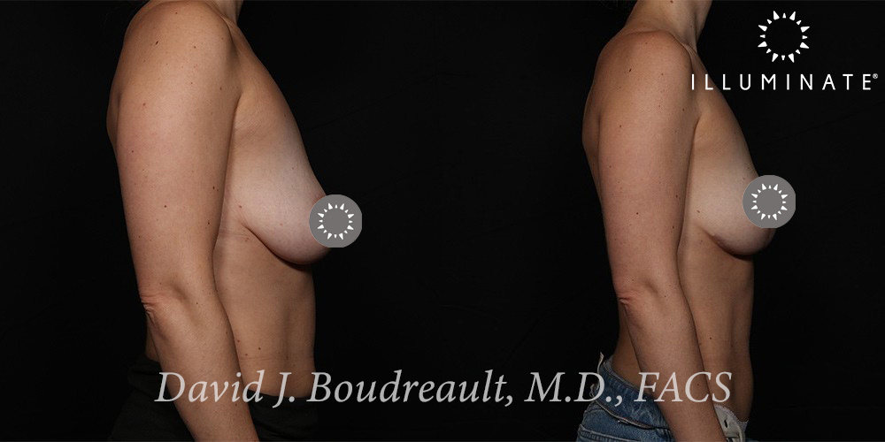 Mastopexy Before & After Image