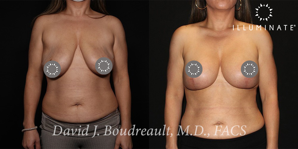 Mastopexy Before & After Image
