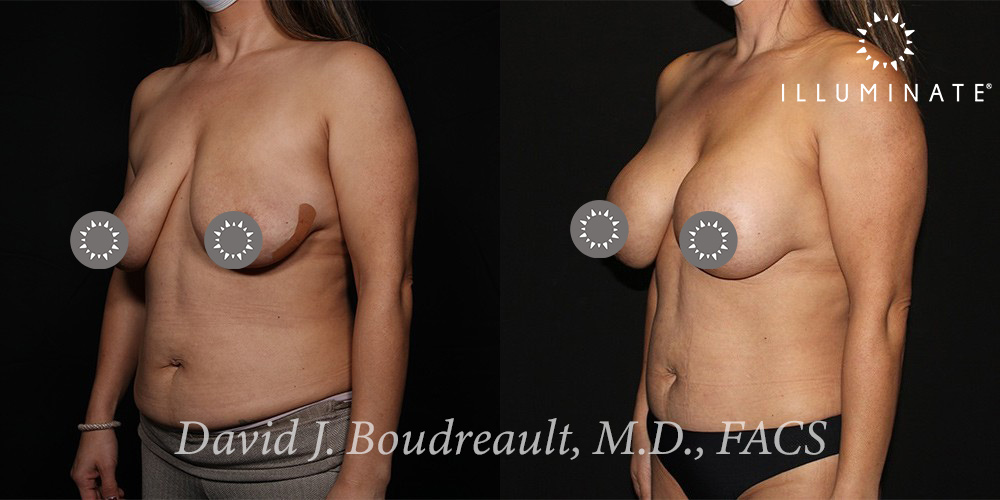 Mastopexy Before & After Image