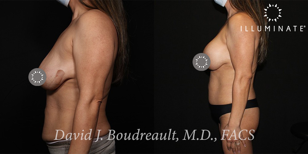 Mastopexy Before & After Image