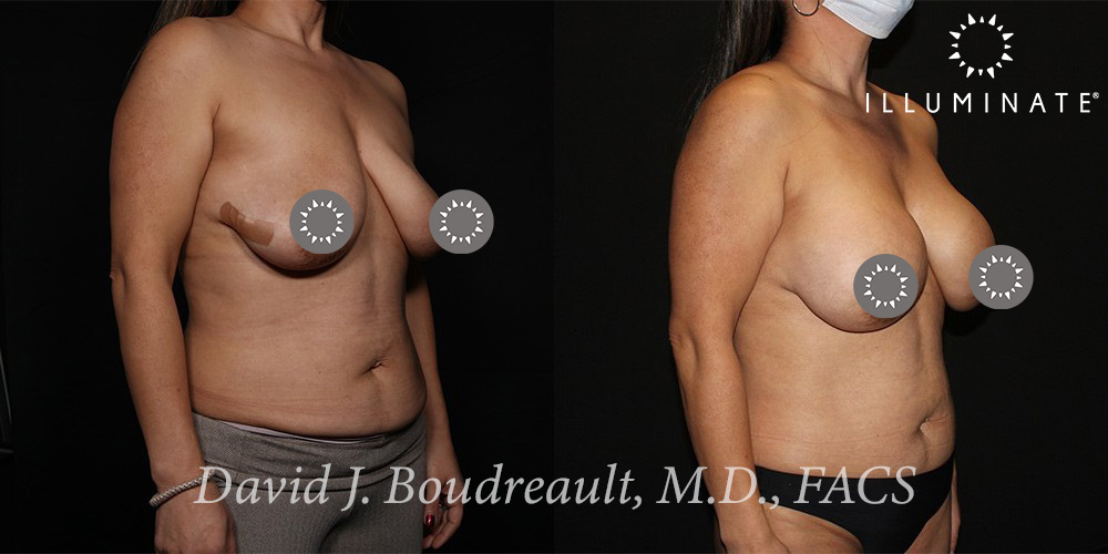Mastopexy Before & After Image