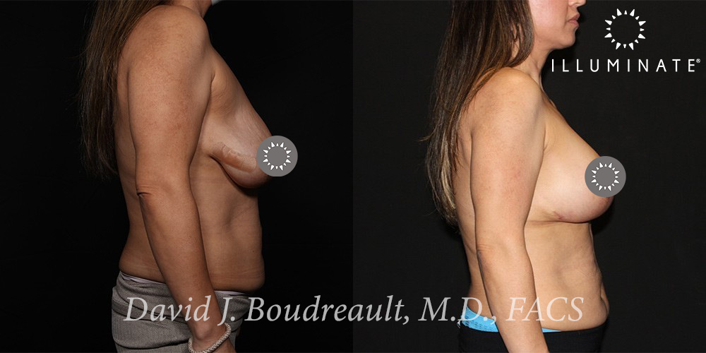 Mastopexy Before & After Image