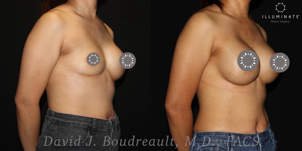 Breast Implant Revision Before & After Image