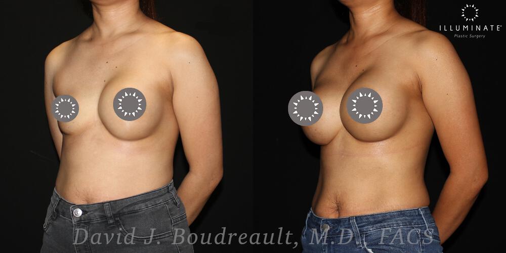 Breast Implant Revision Before & After Image