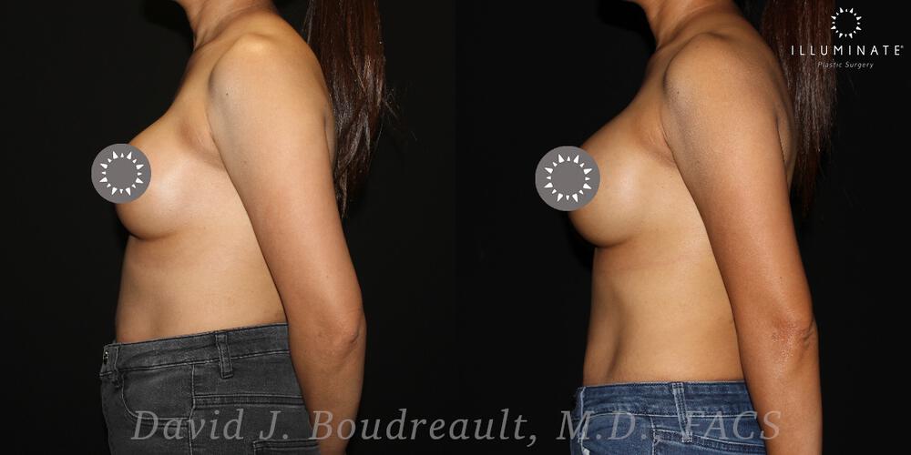 Breast Implant Revision Before & After Image