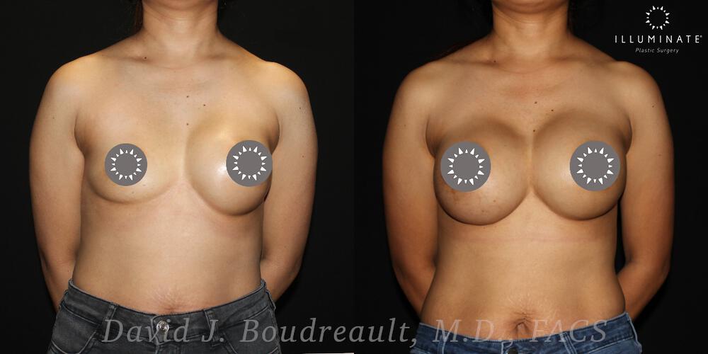 Breast Implant Revision Before & After Image