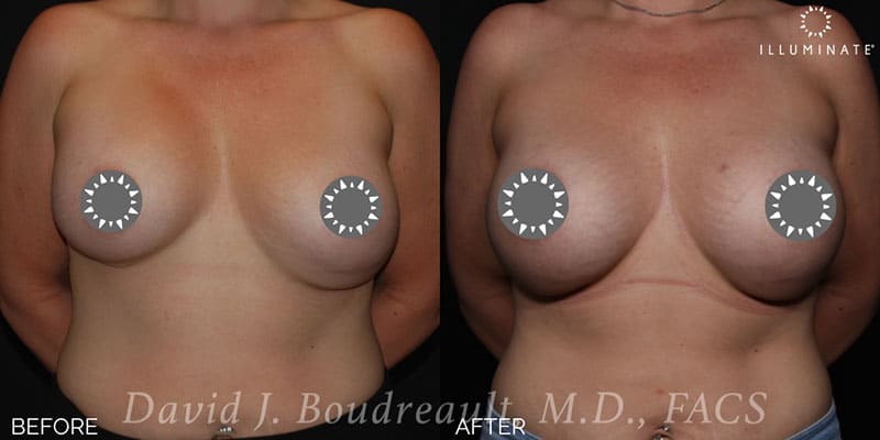 Breast Implant Revision Before & After Image