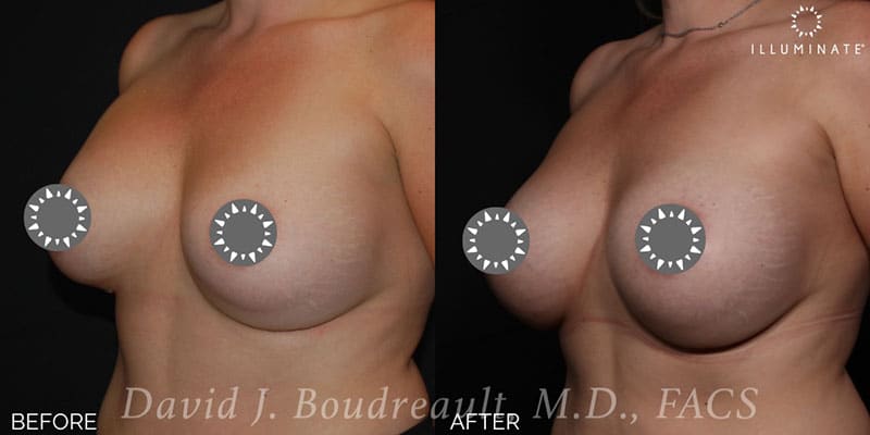 Breast Implant Revision Before & After Image