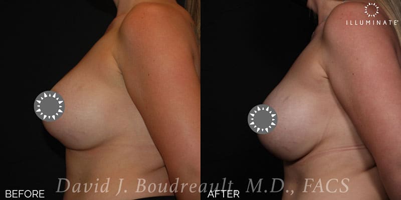 Breast Implant Revision Before & After Image