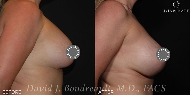 Breast Implant Revision Before & After Image