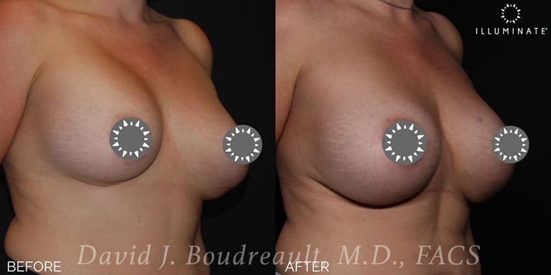 Breast Implant Revision Before & After Image