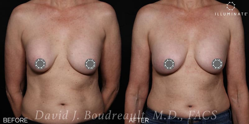 Breast Implant Revision Before & After Image