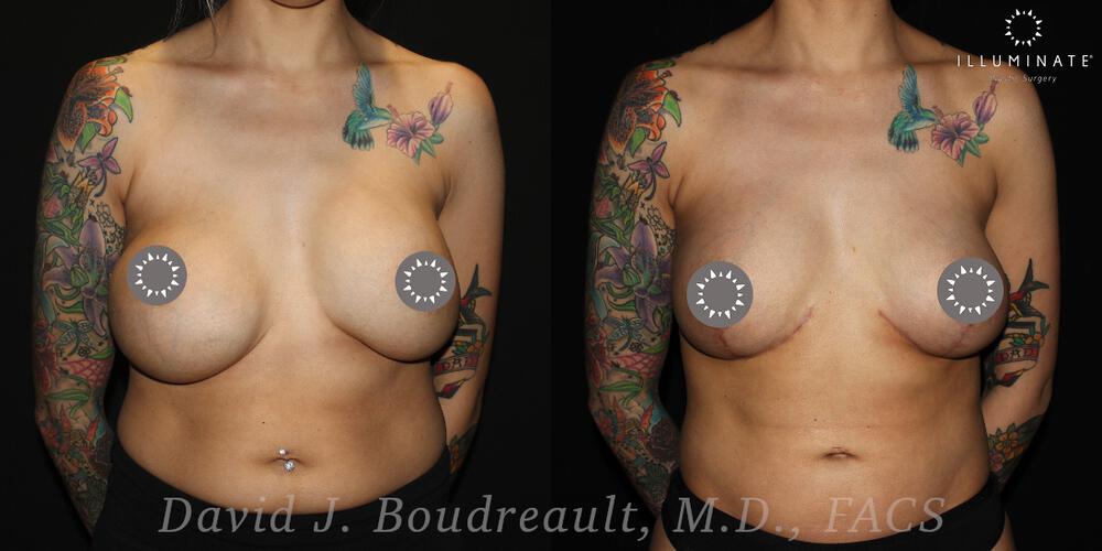 Breast Implant Removal Before & After Image