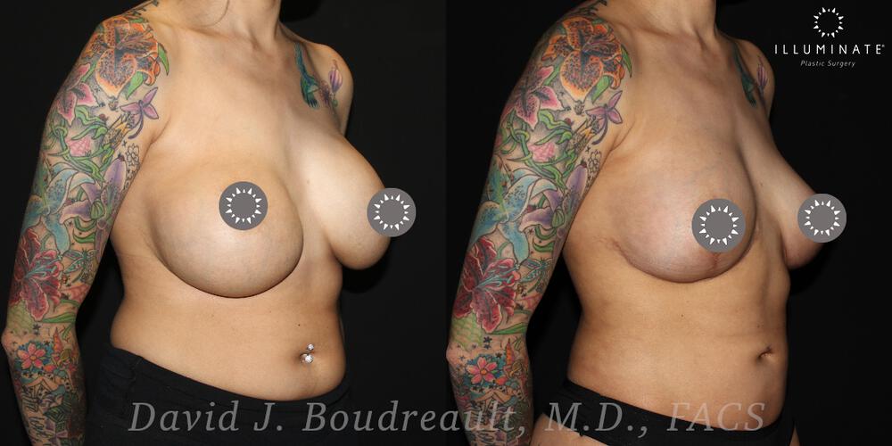 Breast Implant Removal Before & After Image