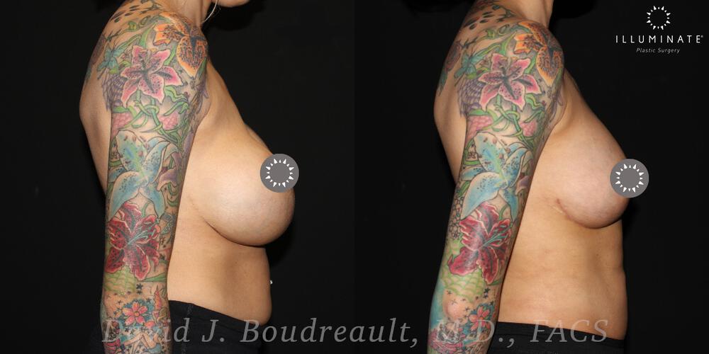 Breast Implant Removal Before & After Image