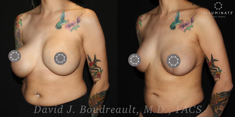 Breast Implant Removal Before & After Image