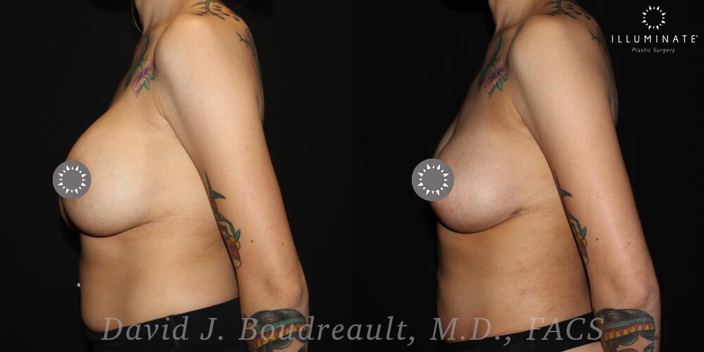 Breast Implant Removal Before & After Image