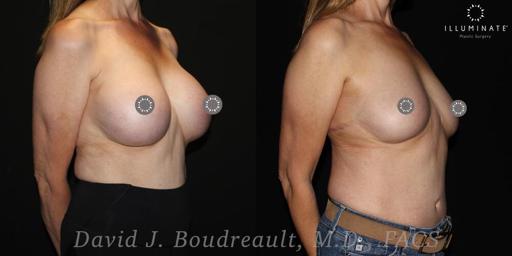 Breast Implant Removal Before & After Image