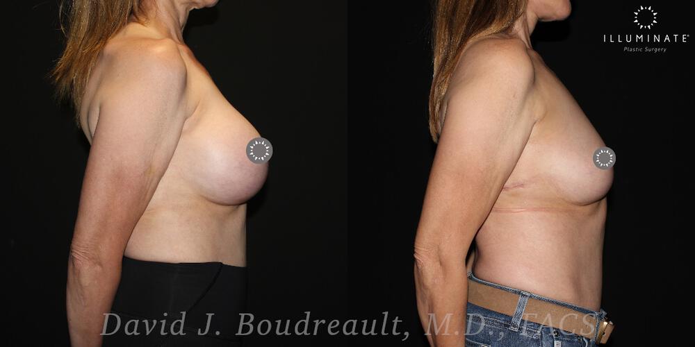 Breast Implant Removal Before & After Image