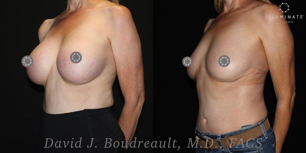 Breast Implant Removal Before & After Image