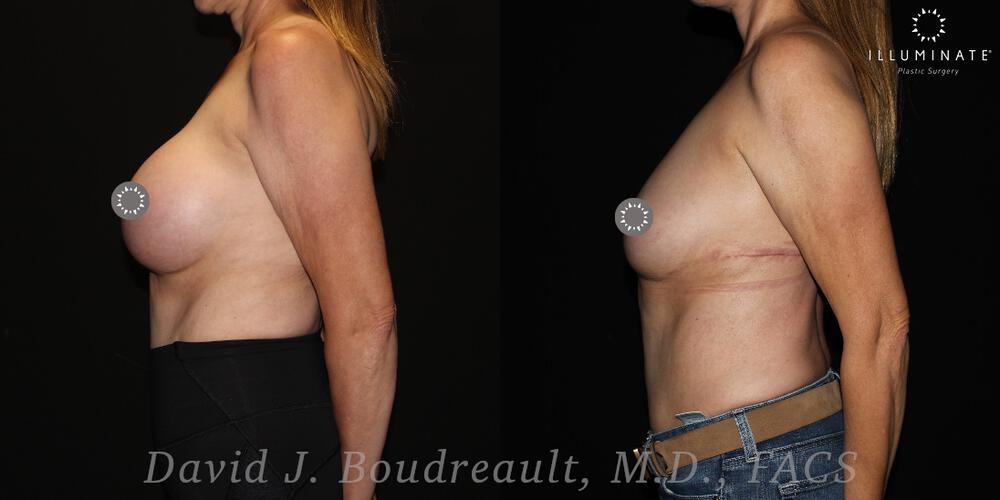 Breast Implant Removal Before & After Image