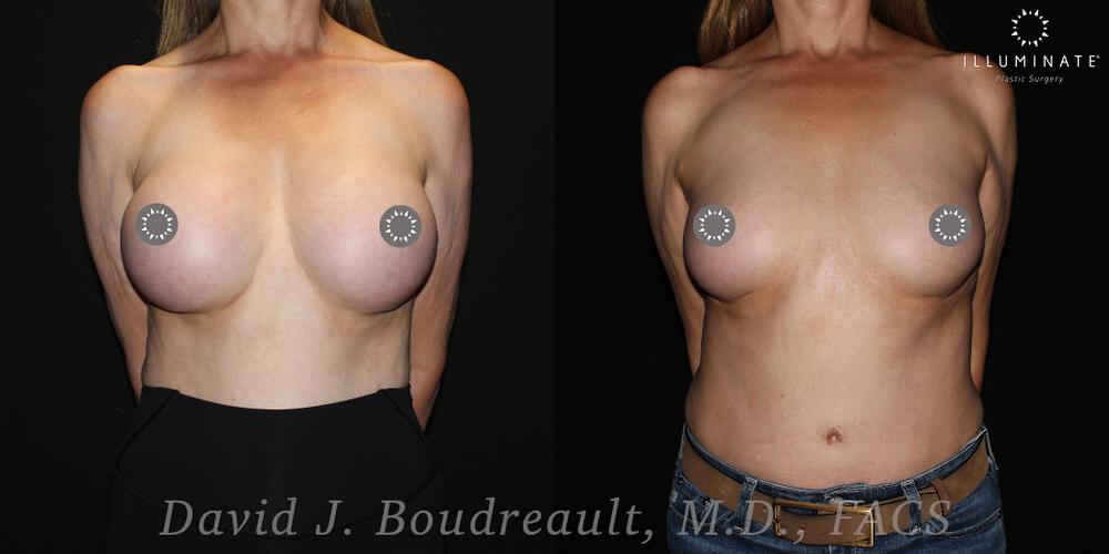 Breast Implant Removal Before & After Image