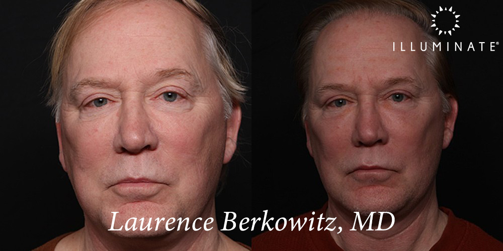 Blepharoplasty Before & After Image