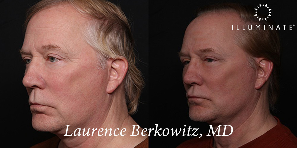 Blepharoplasty Before & After Image