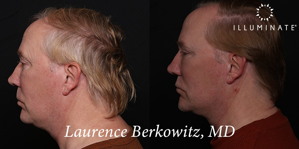 Blepharoplasty Before & After Image