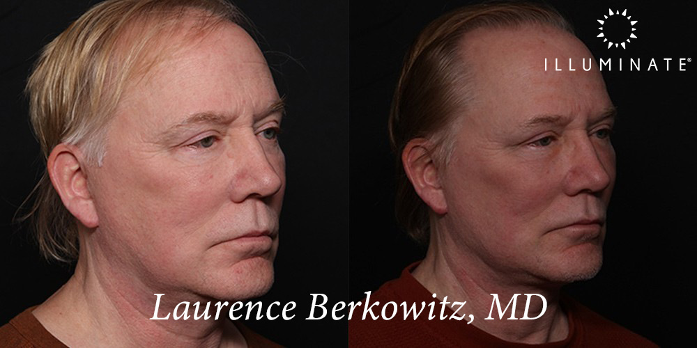 Blepharoplasty Before & After Image